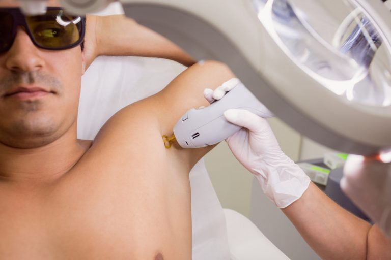 What to Know Before Choosing Laser Hair Removal for Men